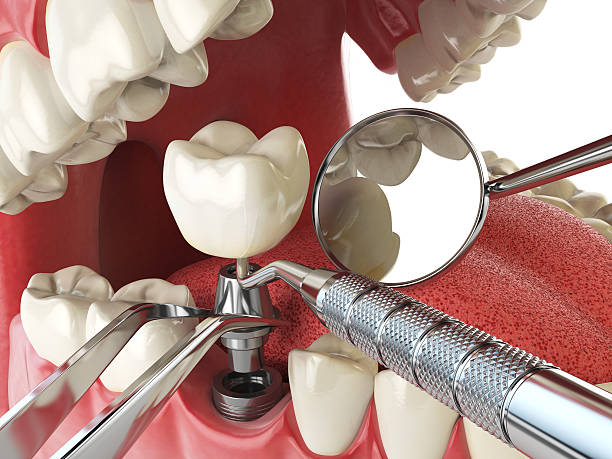 Best Emergency Dentist for Lost Fillings or Crowns in Coatesville, PA